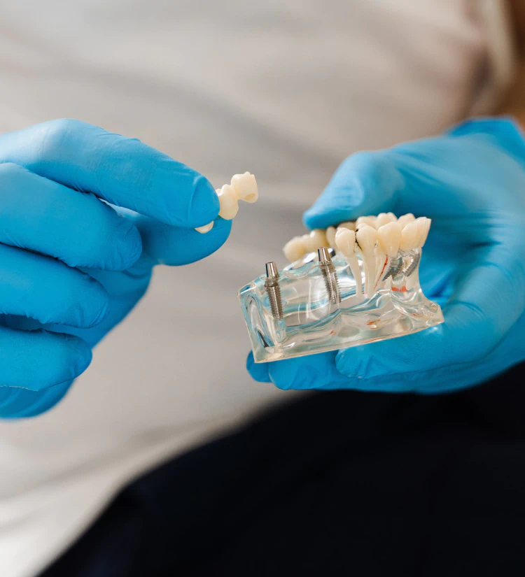 A person wearing blue gloves holds a dental implant model in one hand and a dental bridge in the other, demonstrating how dental implants work.